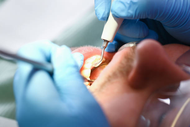 Best Emergency Tooth Extraction  in Ossun, LA