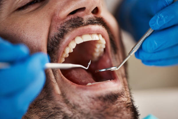 Best Emergency Gum Pain Relief  in Ossun, LA