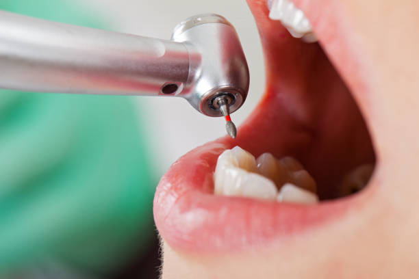 Best Broken Tooth Emergency  in Ossun, LA